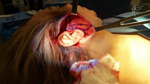 Marking of the SMAS in a Deep Plane Facelift