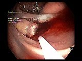 Hybrid ESD/EMR with Semicircumferential Incision, Bleeding and Clips in Ascending Colon • Video • MEDtube.net