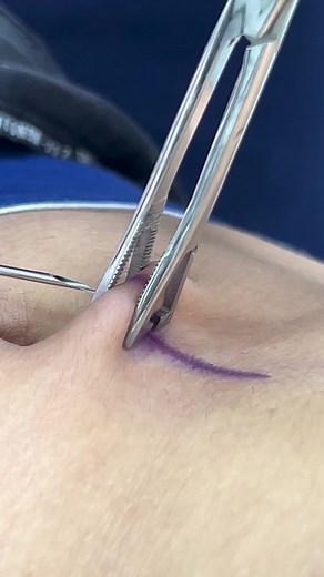 Navel Piercing Procedure in Bogotá, Colombia