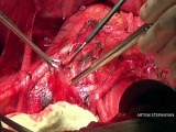 Open Para Aortic Lymphadenectomy • Video • MEDtube.net