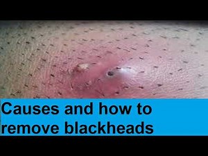 how to remove blackheads