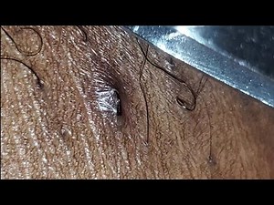 INGROWN HAIR REMOVAL #23
