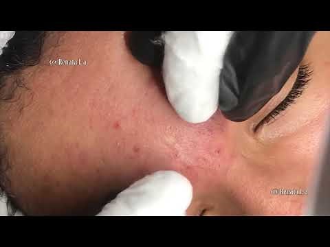 Blackheads - Pimples - PART 1 - Pele com muita Acne - Limpeza de Pele Profunda