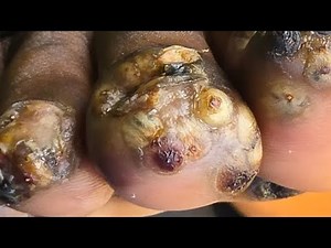 Must See Tungiasis Treatment