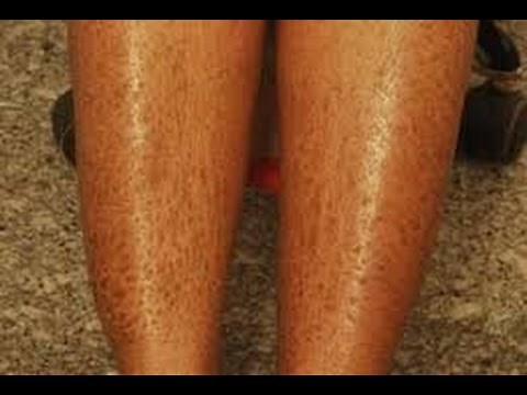 How to Heal Dry Skin on Legs
