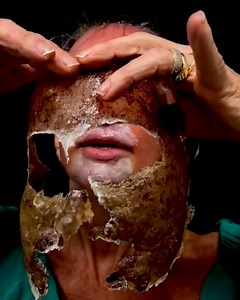 Extreme facial change with phenol peeling! | Outfit Anatomy