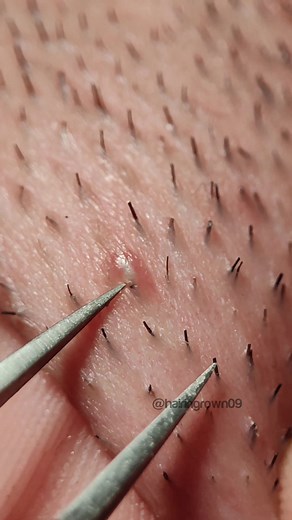 #ingrownhair #waxingvideos #beard #pimple #extractions #tweezers #ingrownhairpull