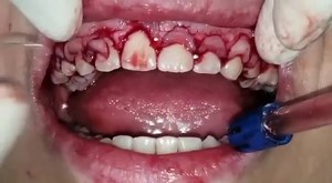 26 reactions | Surgical Crown Lengthening #CrownLengthening | Dr Moin Khan | Facebook