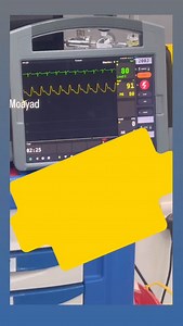 🫀 Cardiac Ischemia – Quick Clinical Reminder! 🚫🩸 Reduced blood flow to the heart muscle ⬇️ Oxygen supply → Myocardial injury 💥 Common Causes: 🧬 Atherosclerosis 🩸 Coronary artery blockage ⚡ Coronary spasm 👩‍⚕️ Early recognition Rapid intervention = Myocardium saved! #CardiacIschemia #EmergencyNursing #CriticalCare #HeartHealth NursingEducation | Moayad Wishah