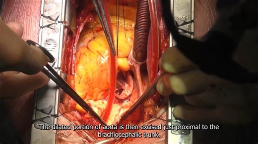 Technique for surgical replacement of the ascending aorta with concomitant aortic valve and hemiarch replacement: a procedural guide | EACTS - European Association for Cardio-Thoracic Surgery