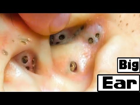 Deep Removal Of Blackheads In The Ear