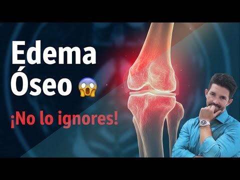 5 Things You Should Know About Bone Edema and Its Treatment