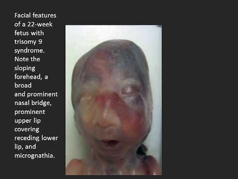 TRISOMY 9 MOSAIC SYNDROME