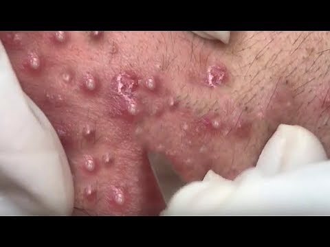 How To Remove Blackheads And Whiteheads On Face Easy #110 ✦ Dr Laelia ✦