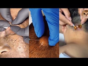 17 Minutes Popping Pimples | Removal Blackheads And Cyst - Best Pimple Popping Compilation Videos #9