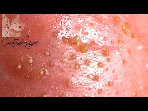 Removing Sebaceous Filaments On the Nose - Blackheads and Whiteheads Extraction (w/o Sound) || 05