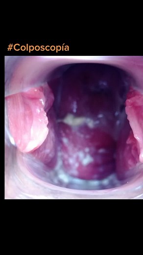 Fotos: 1. Cervix Sano, colposcopía normal 2. Colposcopía anormal 3. Vulvovaginitis por cándida 4. Cáncer de cuello uterino #GyneSalud