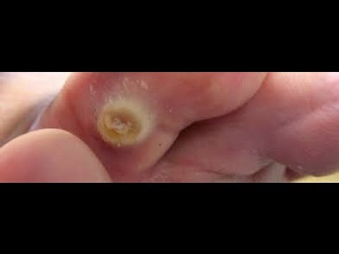 Comment faire pour traiter et guérir les cors