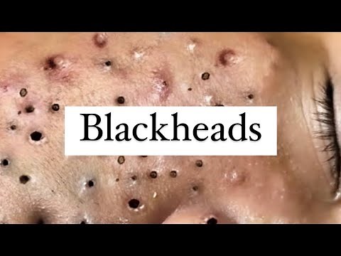 BIGGEST Blackheads, Blackhead, and MORE Blackheads! Blackhead Removal