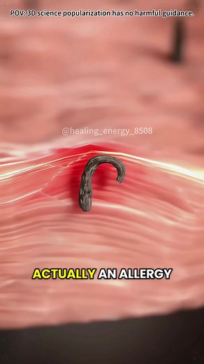 Ingrown Hair Removal 3D Animation: Laser Treatment Explained