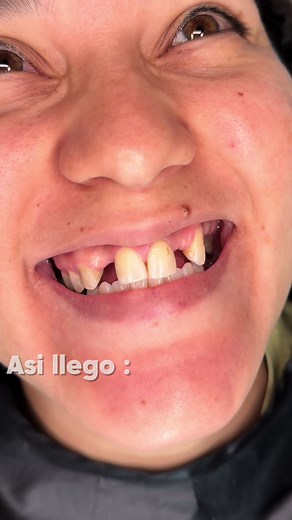 #diseñodesonrisa #carillasdentales #protesisdentales #coronadentalestetica