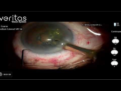 Live Surgical Demonstration: Femto Laser–Assisted Cataract Surgery with Eyhance IOL Dr Gaurav Luthra