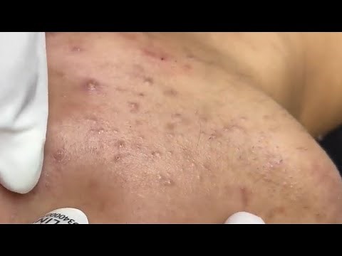 MyLinh Relaxing Deep Facial Cleaning | Gentle Skincare Session #541