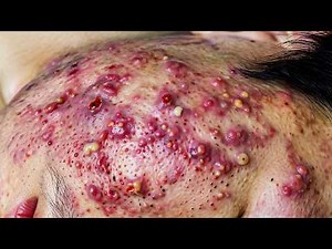 Worst Acne Ever?! Deep Cystic Acne Removal & Recovery | Acne Treatment