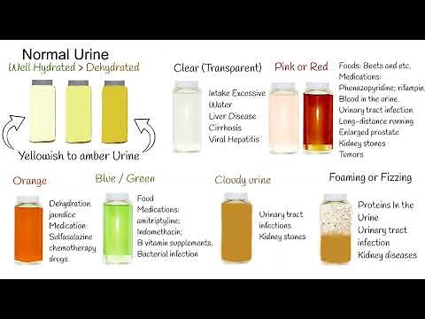Understanding Urine Color. Foamy urine, Dark Urine, Red Urine, Green Urine, Cloudy Urine