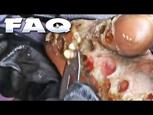 Tunga Penetrans; Jigger Removal FAQs