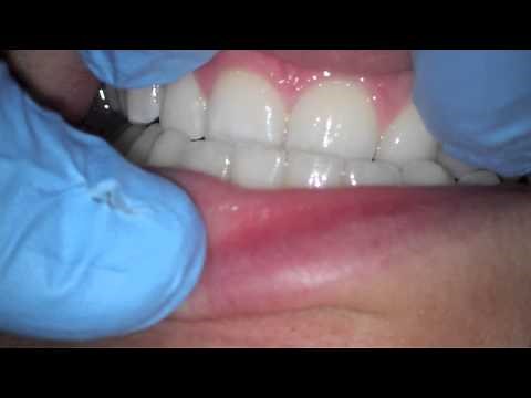 loose tooth and recession from biting forces (occlusal trauma)