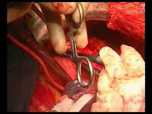 Thoraco-Abdominal Graft