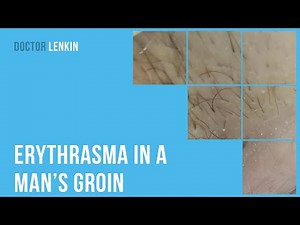 😲 Erythrasma in a man’s groin