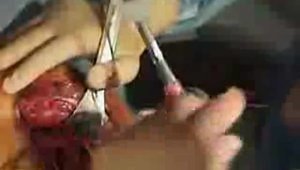 DJO AltiVate Reverse Shoulder Replacement for Acute Fracture featuring the Black and Tan Technique