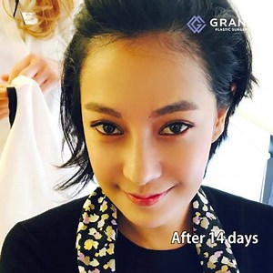 Look this amazing transformation! She had eye surgery, rhinoplasty, facial contouring and breast augmentation at GRAND.♥️ For free consultation Tel: (+82) 70-7119-1580 Mobile: (+82) 10-7156-6546(Whatsapp, Line, Kakaotalk, Viber, iMessage) Email: grandps.en@gmail.com Facebook: facebook.com/grandplasticsurgery Webstie: eng.grandsurgery.com Pinterest : https://www.pinterest.co.kr/grandps_eng/ Tumblr: http://grandsurgery.tumblr.com/ Instagram: grandps_eng #grandplasticsurgery #plasticsurgery #liposu