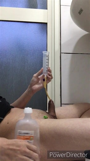 Expanding bladder with 1000mL saline - ThisVid.com