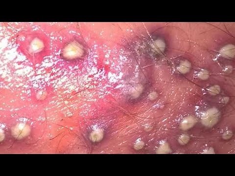 Worst Pimples I Have EVER Seen! Pimple Popping & Zit Removal