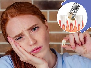 Impacted Wisdom Teeth: What are they? Should you get them removed?