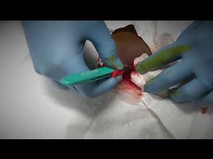 boil in the back - drainage of pus