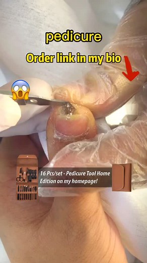 hope you don't have such troubes #foryou #satisfying #pedicurekit #toenail #pedicure #podologia #ingrowntoenail