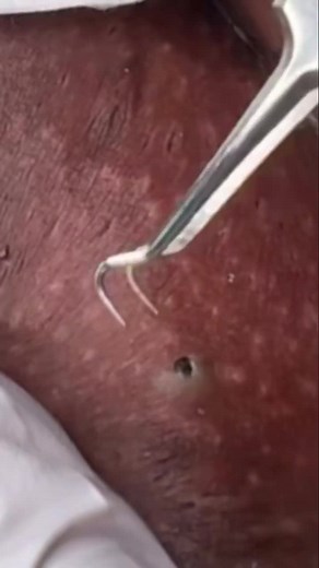 POV: That stubborn ingrown hair thought it was staying rent-free. 😌✨ #IngrownExtraction #extractions #Ingrownhair #blackhead #memphisesthetician