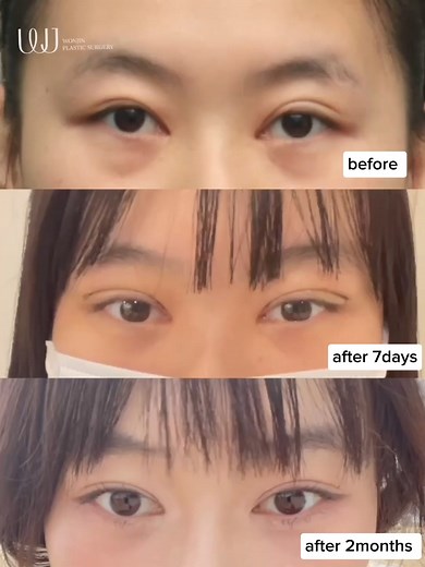 Upper blepharoplasty with under eye fat repositioning (improves the...