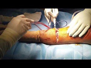 Foot amputation to Below Knee Amputation