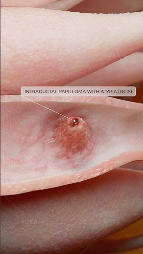 Intraductal papilloma with atypia: a complex breast condition explained in 3D