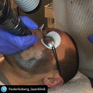 Spectra XT kallas den utökade plattformen av en anledning. ⚡️ Vi vill berätta om två nya behandlingar som endast Spectra XT erbjuder på marknaden idag: Gold 💰 Toning (595 nm) – Enstegslösningen för hudrodnad och akne. Gold Toning-behandlingen lättar rodnad efter akne och hjälper också till att minska inflammatorisk akne på grund av dess egenskaper där blodkärl i onormalt tillstånd återgår till sitt normala tillstånd genom fotobiomodulerande effekter. Revital 🧖‍♀️ Treatment (1064 nm) – En optim