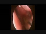 Sphenoid Sinus Pyocele • Video • MEDtube.net