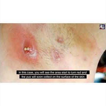 How to treat boils | Furunculosis | Carbuncle