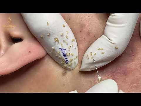 Acne is like a good grain of rice (154) | Loan Nguyen