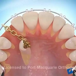 Management of impacted canine with surgical exposure and alignment by orthodontic treatment 💉🦷 | Dentistry blog