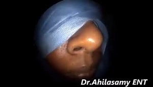 Total Sphenoethmoidectomy Under Local Anesthesia for Ethmoid and Sphenoid Fungal Sinusitis